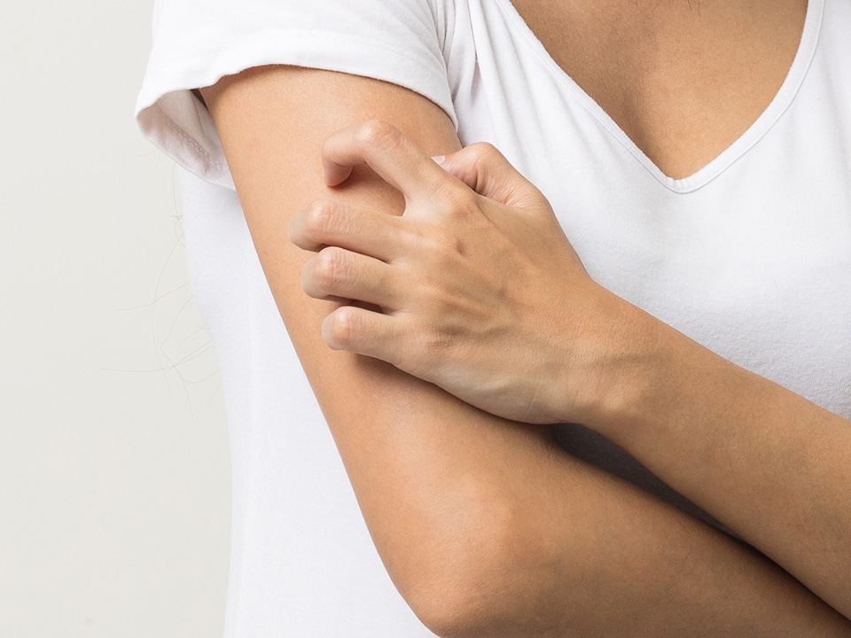 Kiusaavatko näpyt käsivarsissa?