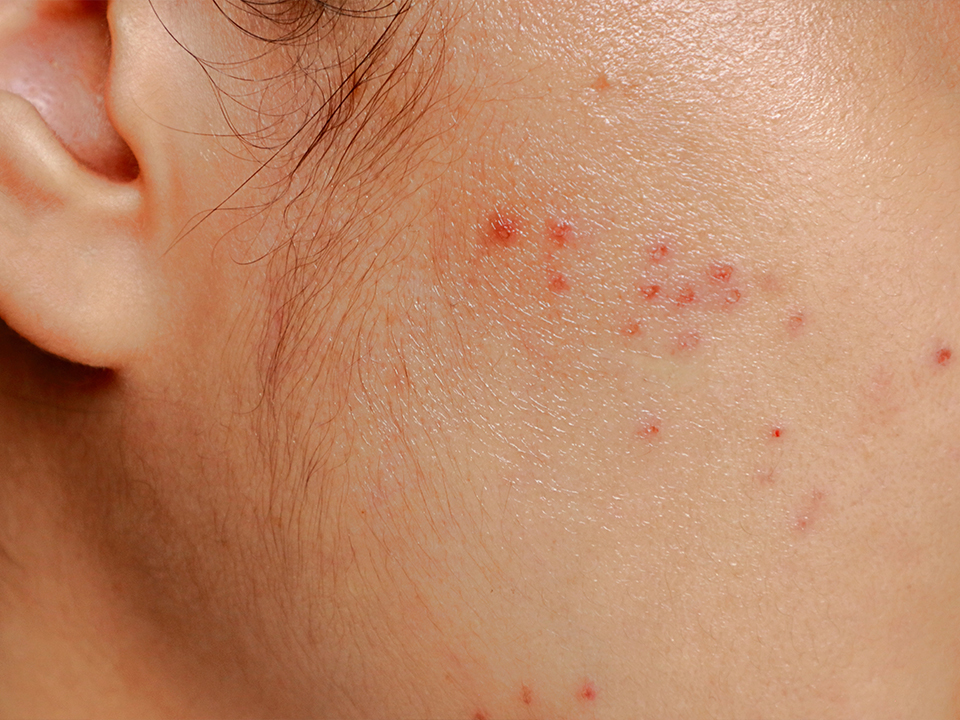 Aikuisiän iho-ongelmat hormonaalisen ehkäisyn jälkeen